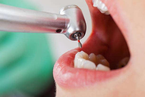 Best Emergency Treatment for Dental Infections or Abscesses in Farmingdale, NY